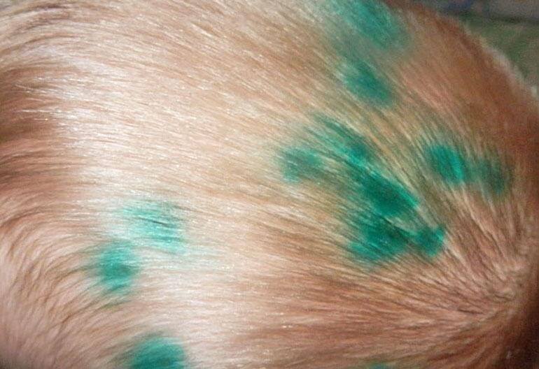 Как быстро отмыть зеленку с кожи, линолеума, одежды, мебели и других поверхностей